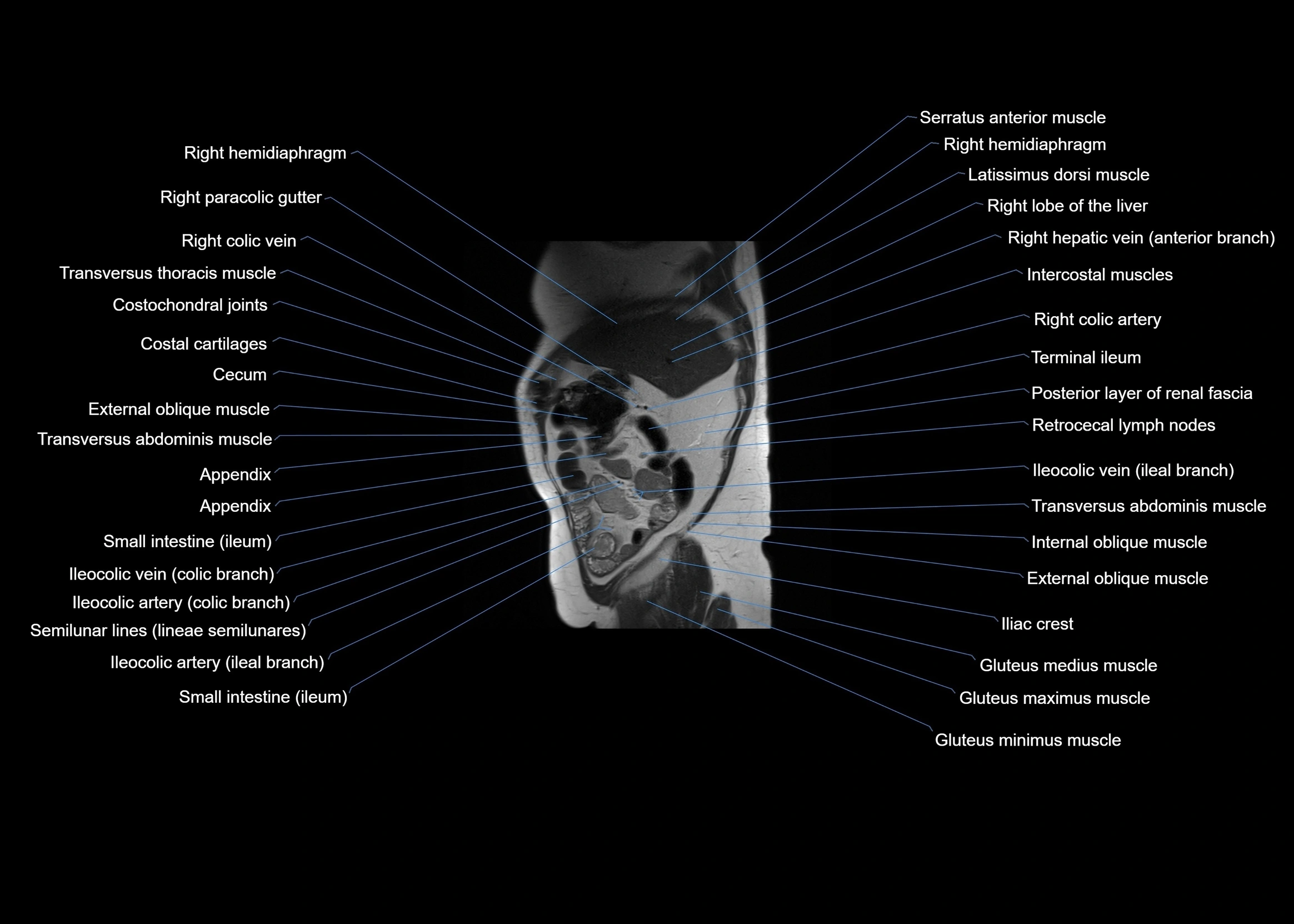 MRI abdomen sagittal cross sectional anatomy  radiology  image-img-00001-00014.webp